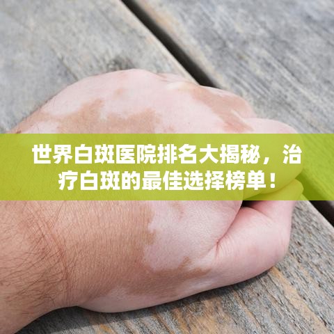 世界白斑医院排名大揭秘，治疗白斑的最佳选择榜单！