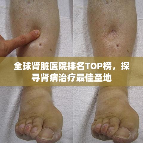 全球肾脏医院排名TOP榜，探寻肾病治疗最佳圣地