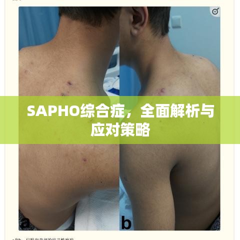 SAPHO综合症，全面解析与应对策略