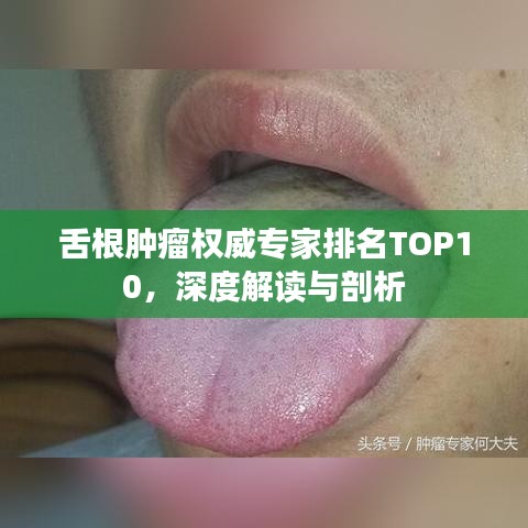舌根肿瘤权威专家排名TOP10，深度解读与剖析